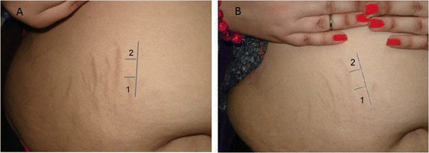 Before and after Nd: YAG stretch mark laser removal