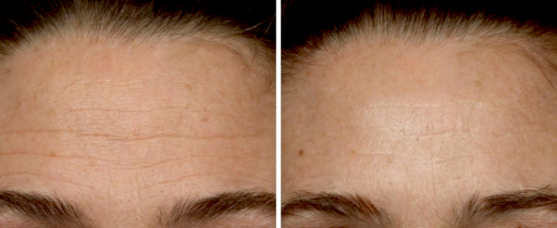 Forehead before and after the treatment with NuFace device after 60 days