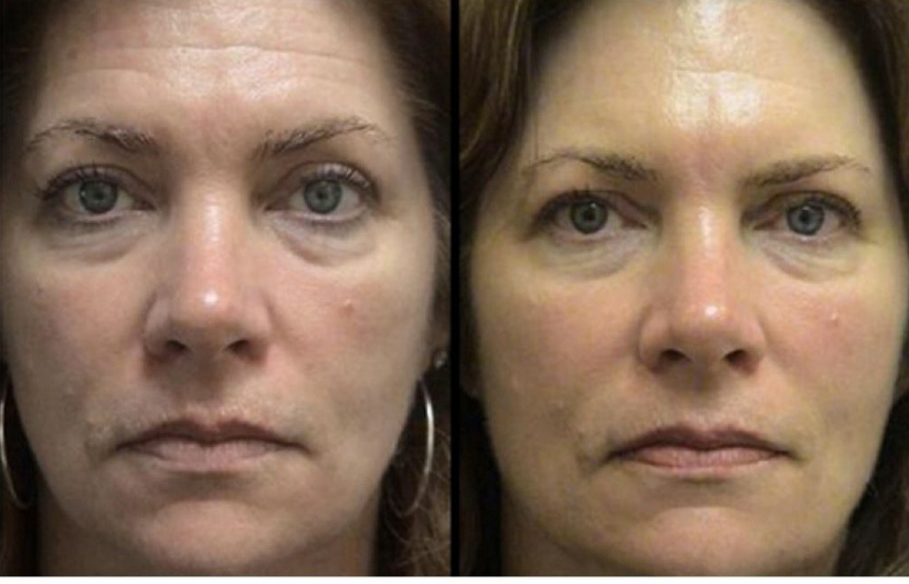 Result of treating wrinkles and fine lines with red light therapy
