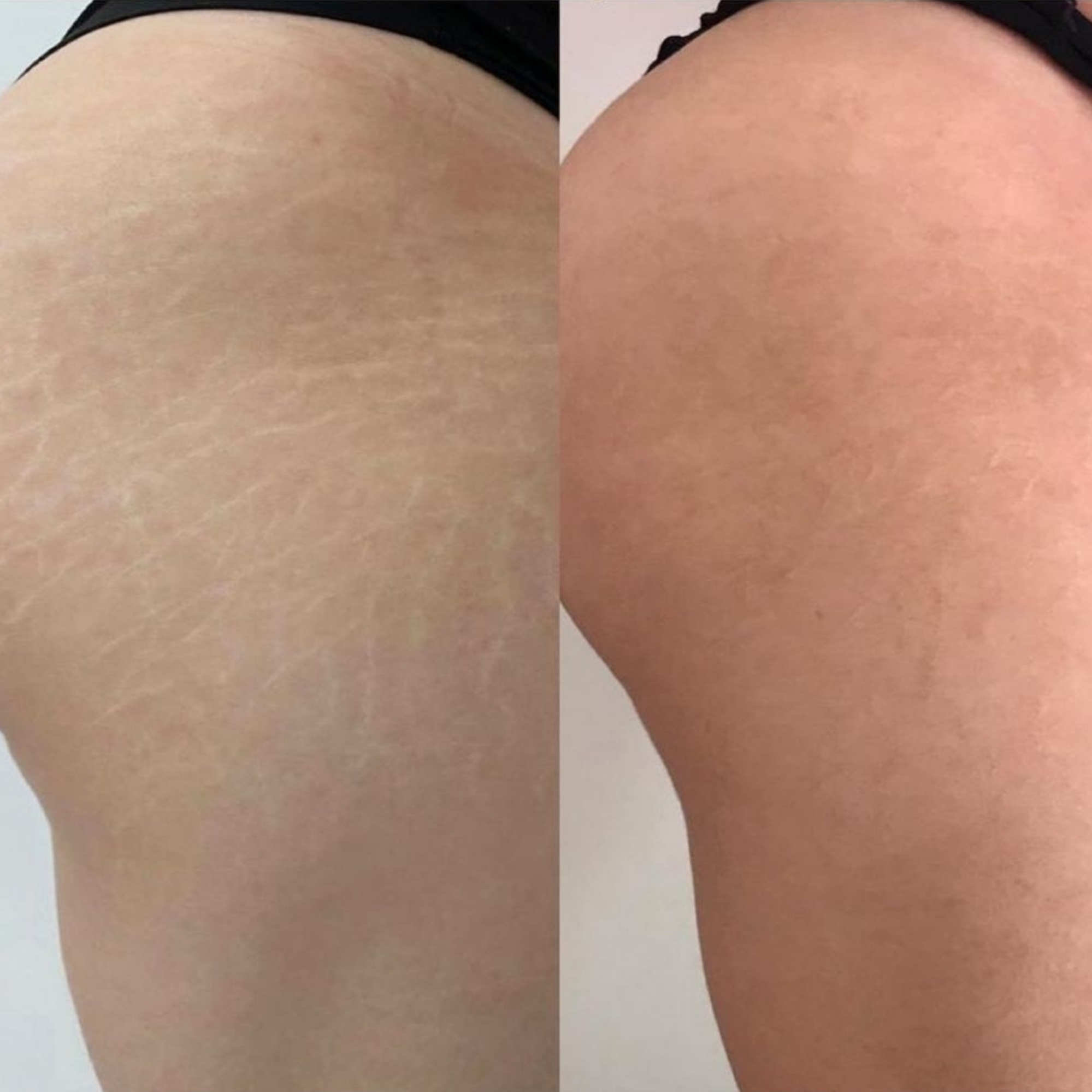 Before and after stretch mark laser removal on the thighs