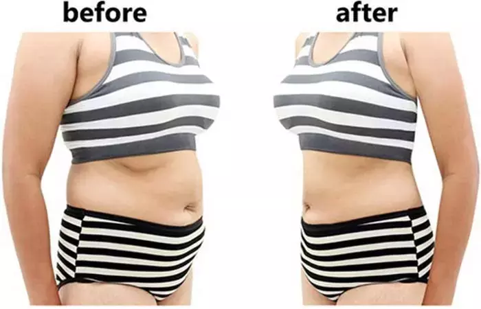 Before & After 15 treatments with fat-burning machines