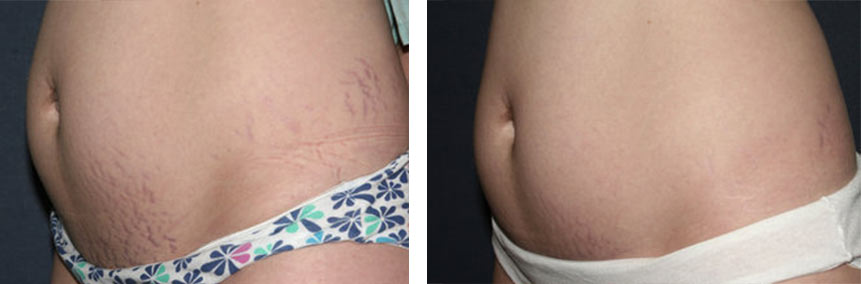 Before and after stretch mark laser removal on the abdomen