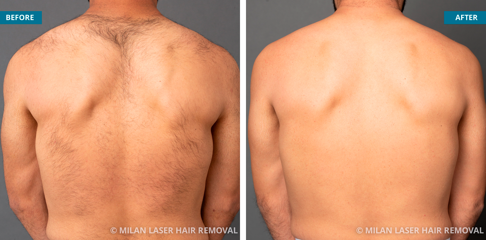 Men’s back after sessions at Milan laser hair removal Source: Milan laser hair removal