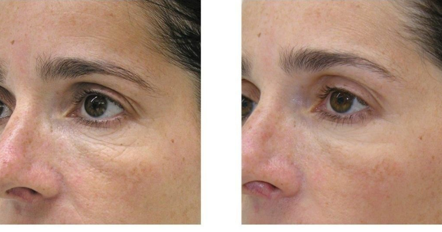 Result of treating wrinkles and fine lines with red light therapy
