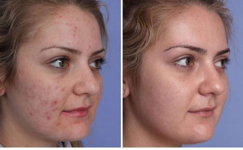 Result of red light therapy treatment for acne