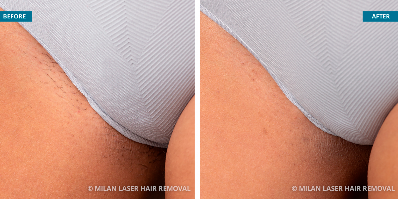 Is Milan Laser Hair Removal Worth Its Money? Honest Review