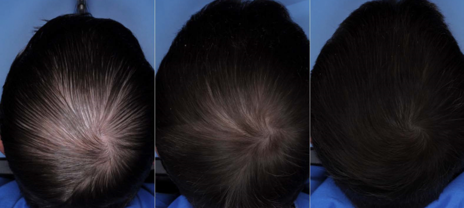 The result of using red light therapy for hair growth in men
