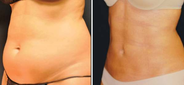 The result of using a laser lipo on the abdomen