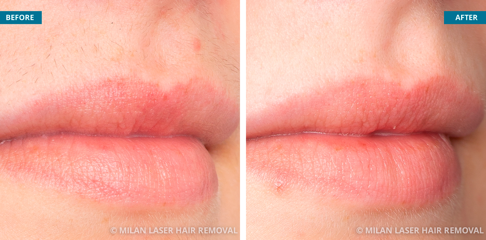 Upper lip area after sessions at Milan laser hair removal Source: Milan laser hair removal