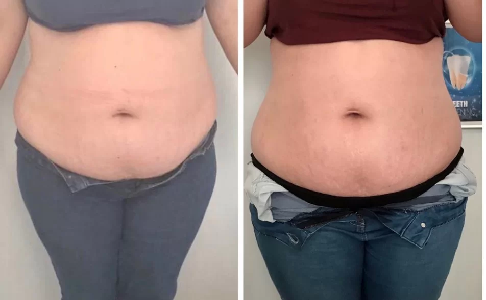 body contouring machine before and after