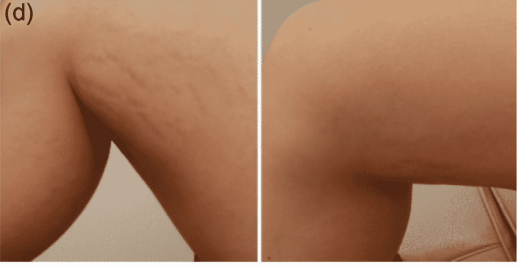Before and after Excimer stretch mark laser removal