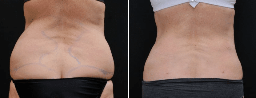 The result of using a laser lipo on the sides and back