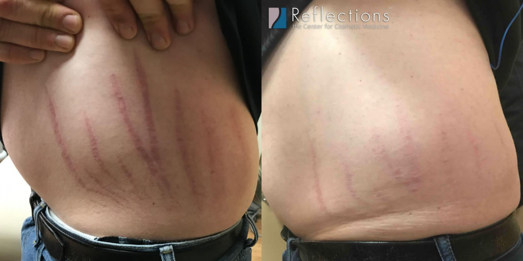 Before and after fractional CO2 stretch mark laser removal