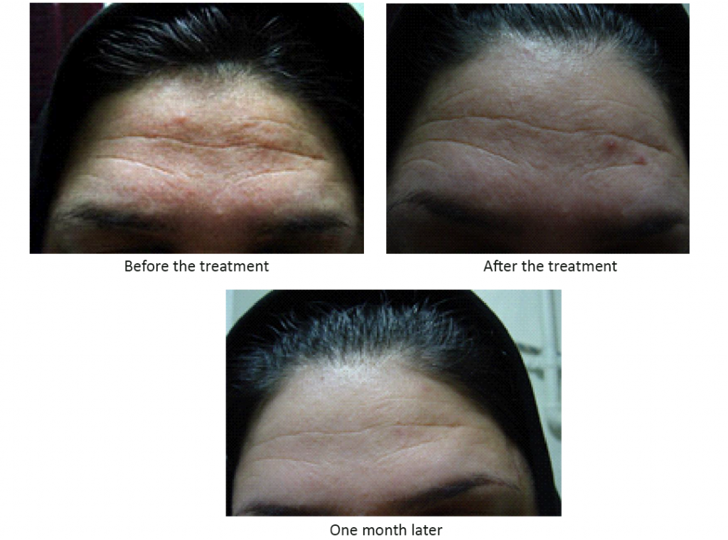 Photo of the patient: before, after, and one month post the microcurrent treatment [3]