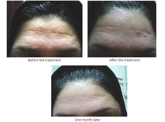 Photo of the patient: before, after, and one month post the microcurrent treatment [3]