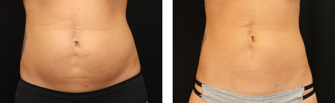 The result of using a laser lipo on the abdomen
