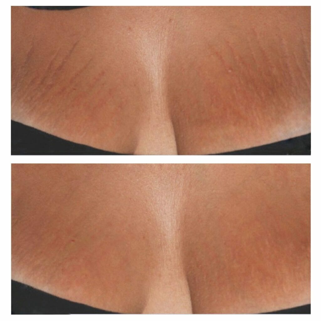 Before and after Er: YAG stretch mark laser removal