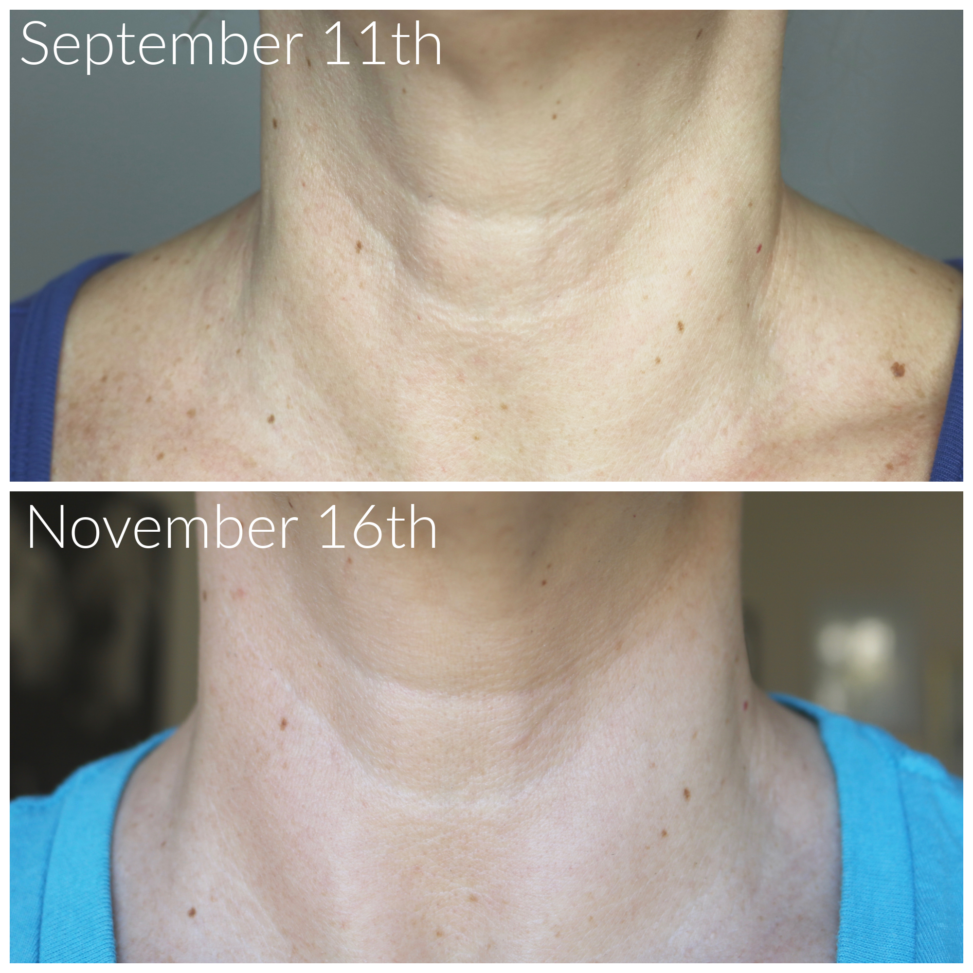 Before and after results after 60 days of NuFace