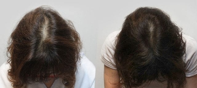 The result of using red light therapy for hair growth in women