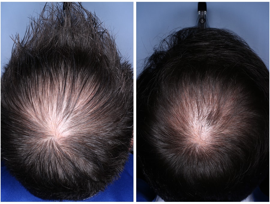 The result of using red light therapy for the treatment of hair loss