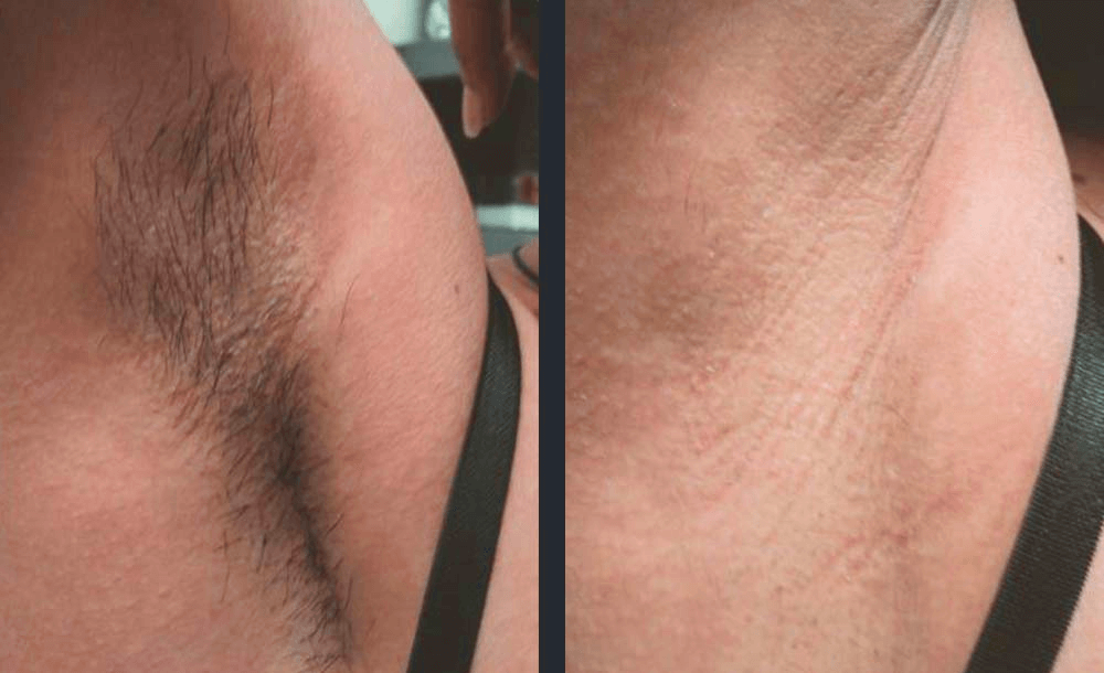 Armpit after treatment with Candela GentleMax Pro (the laser used in Milan laser hair removal) Source: Candela