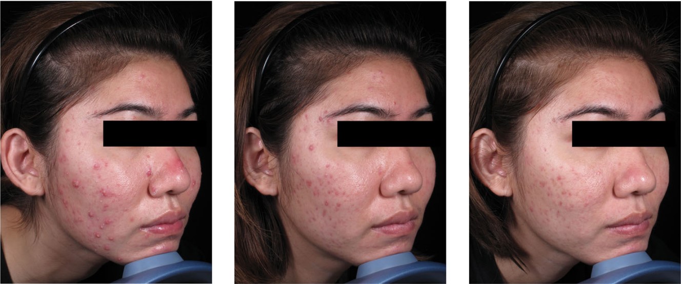 The result after 4 weeks of treatment with blue LED light (470 nm) and red LED light (640 nm). A - baseline, B - 1 week after the final treatment, C - 8 weeks after the final treatment