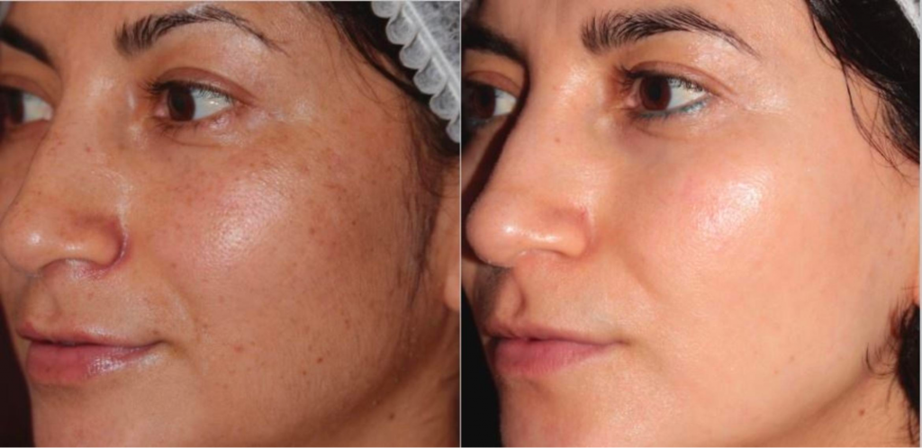 The result of using reVive light therapy for anti-aging