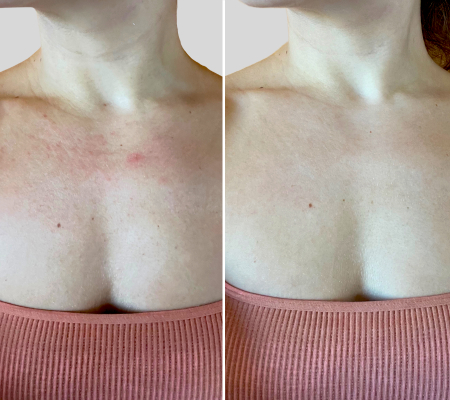 Before & after using Omnilux Contour Neck & Décolleté for 4 weeks 