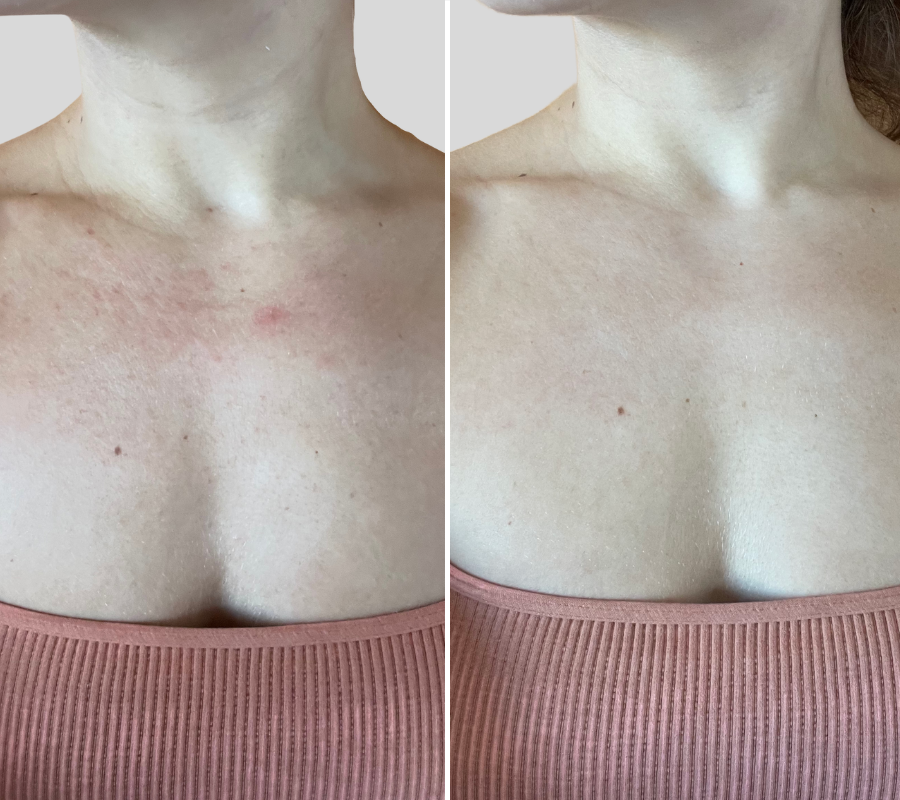 Before & after using Omnilux Contour Neck & Décolleté for 4 weeks 