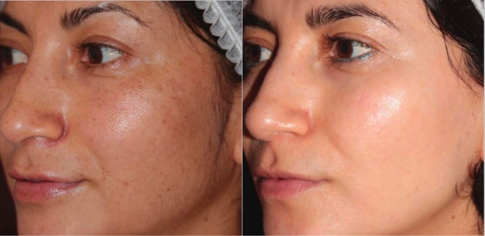 The result of using reVive light therapy for anti-aging