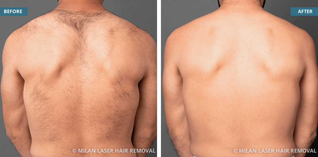 Bikini after the completed laser hair removal Source: Milan laser hair removal