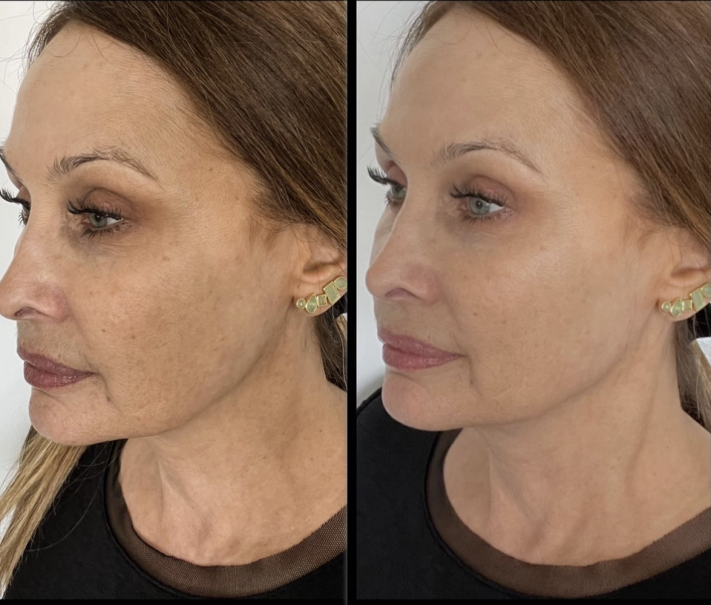 Results after using Omnilux Contour Face for 6 weeks