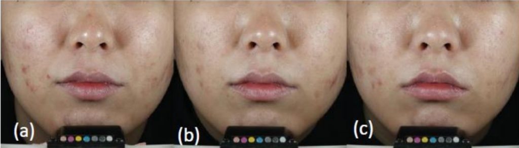 The right side was treated with 2% salicylic acid (SA), and the left side was treated with 5% benzoyl peroxide +0.1% adapalene gel. Photos were taken on the 1, 14, and 28 days of treatment