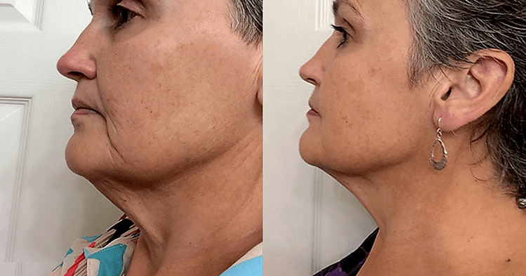 Before & after 16 weeks of use of LightStim for Wrinkles