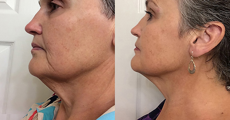 Before & after 16 weeks of use of LightStim for Wrinkles