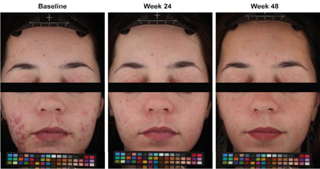 Before and after results from the treatment with 0.3% adapalene and 2.5% benzoyl peroxide. The left side received treatment, the left got a vehicle for the first 24 weeks, and the treatment was during the following 24 weeks