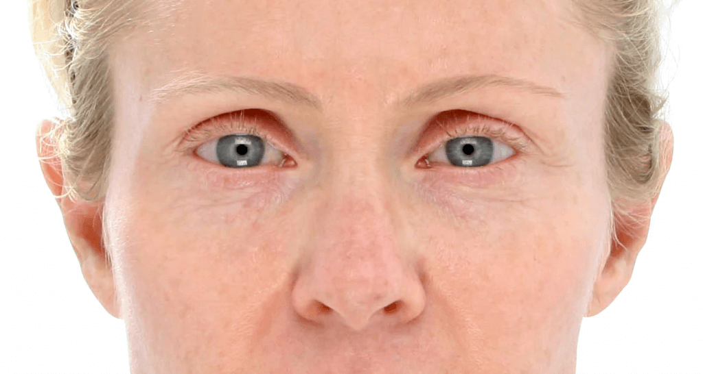 Before & after 12 weeks of use of LightStim for Wrinkles Source: lightstim.com