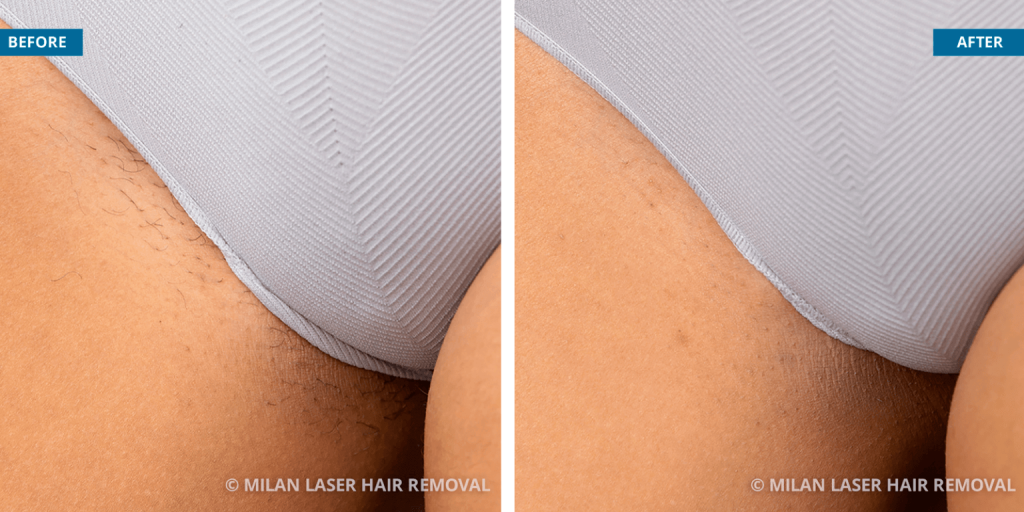 Bikini after the completed laser hair removal Source: Milan laser hair removal