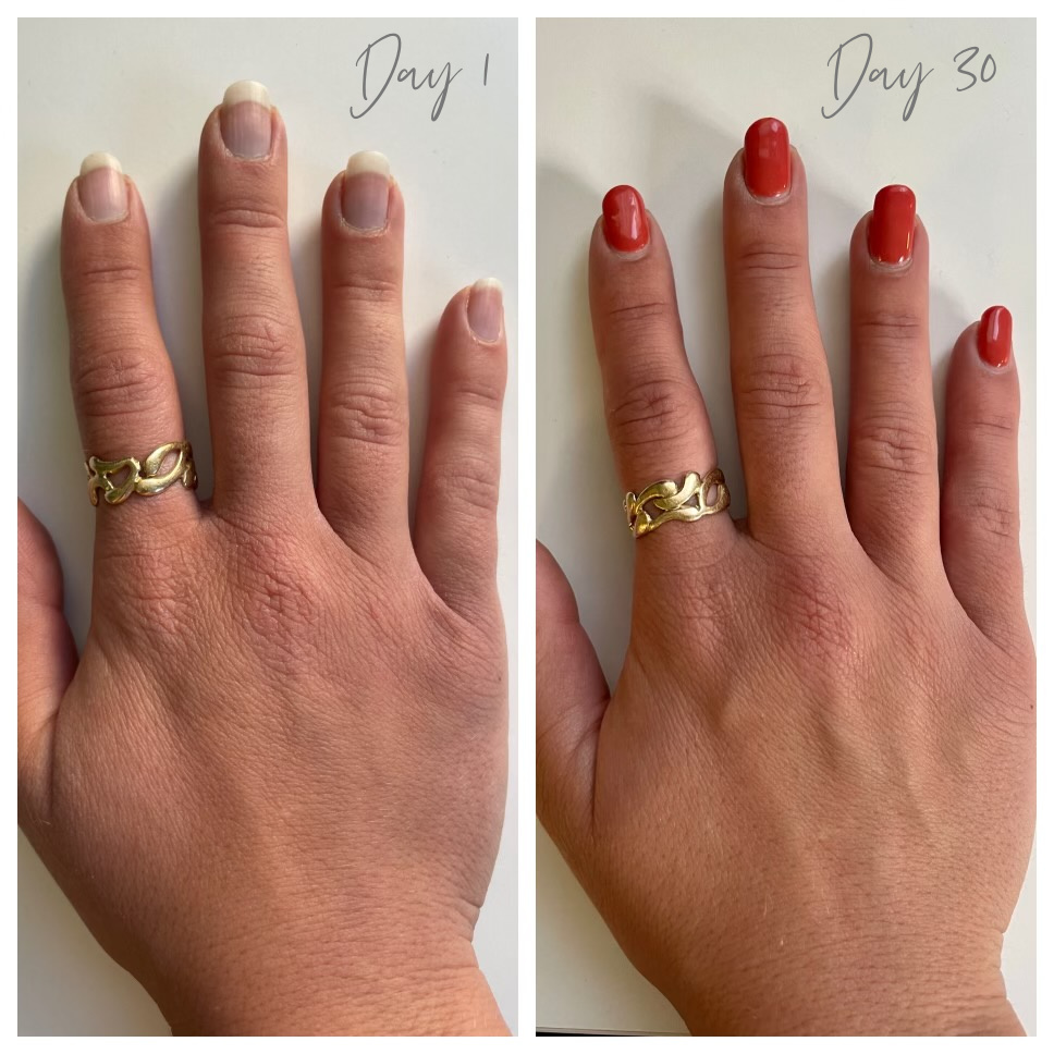 Results after using Omnilux Contour Glove for 30 days