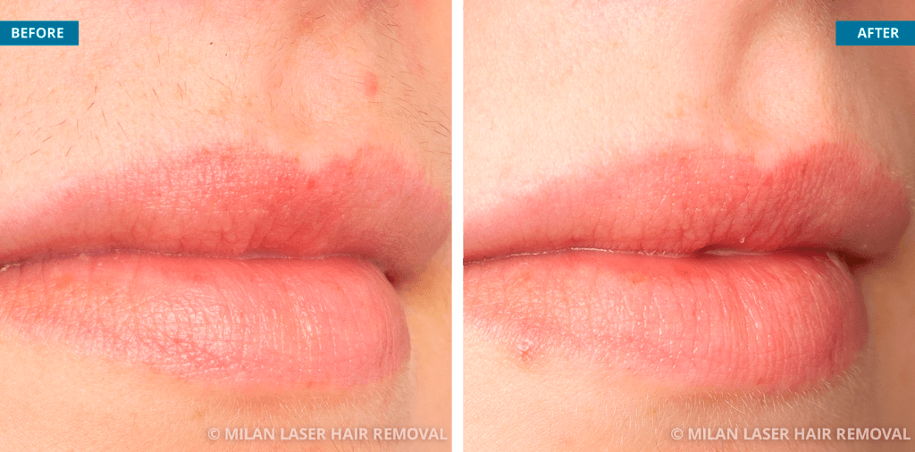 Upper lip area after sessions at Milan laser hair removal Source: Milan laser hair removal