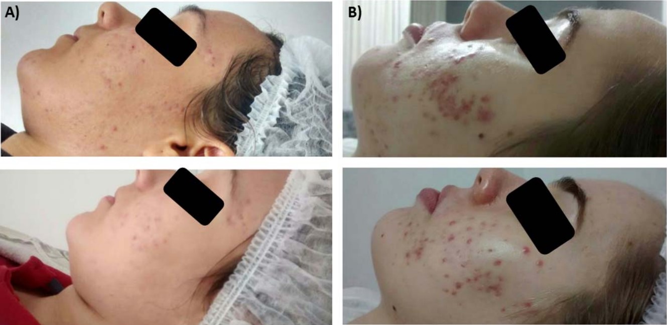 Before and after photos of patients after treatment with salicylic acid (A) and blue (470 nm) and red (660nm) light therapy (B)