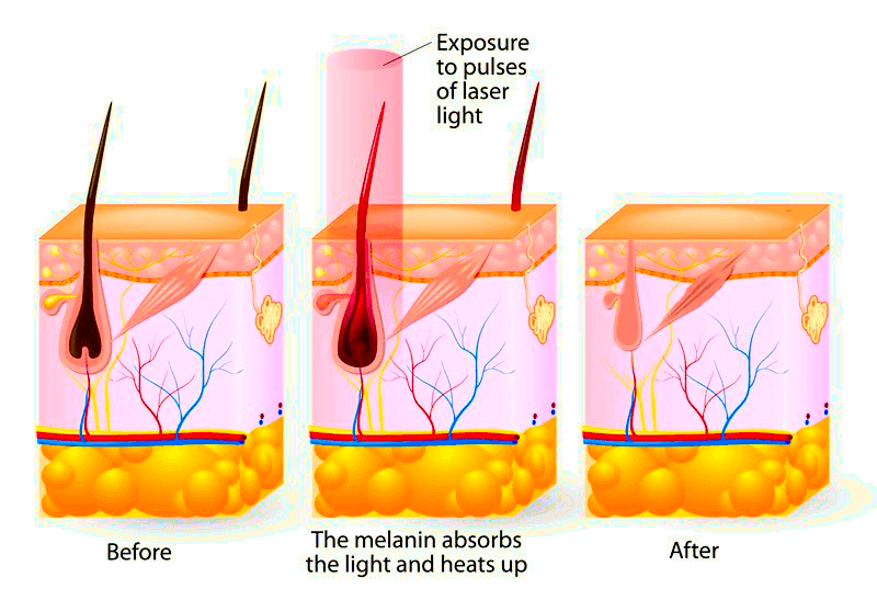 The working principle of laser hair removal. When the melanin heats up it destroys hair follicles and prevents further growth