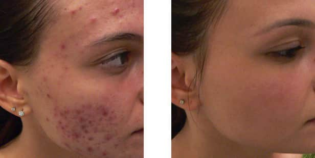 The result of using reVive light therapy for acne treatment