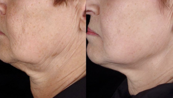 Result of using light therapy for skin tightening