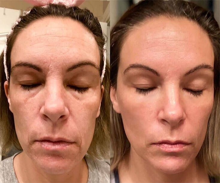 The result of using red light therapy wand for anti-aging