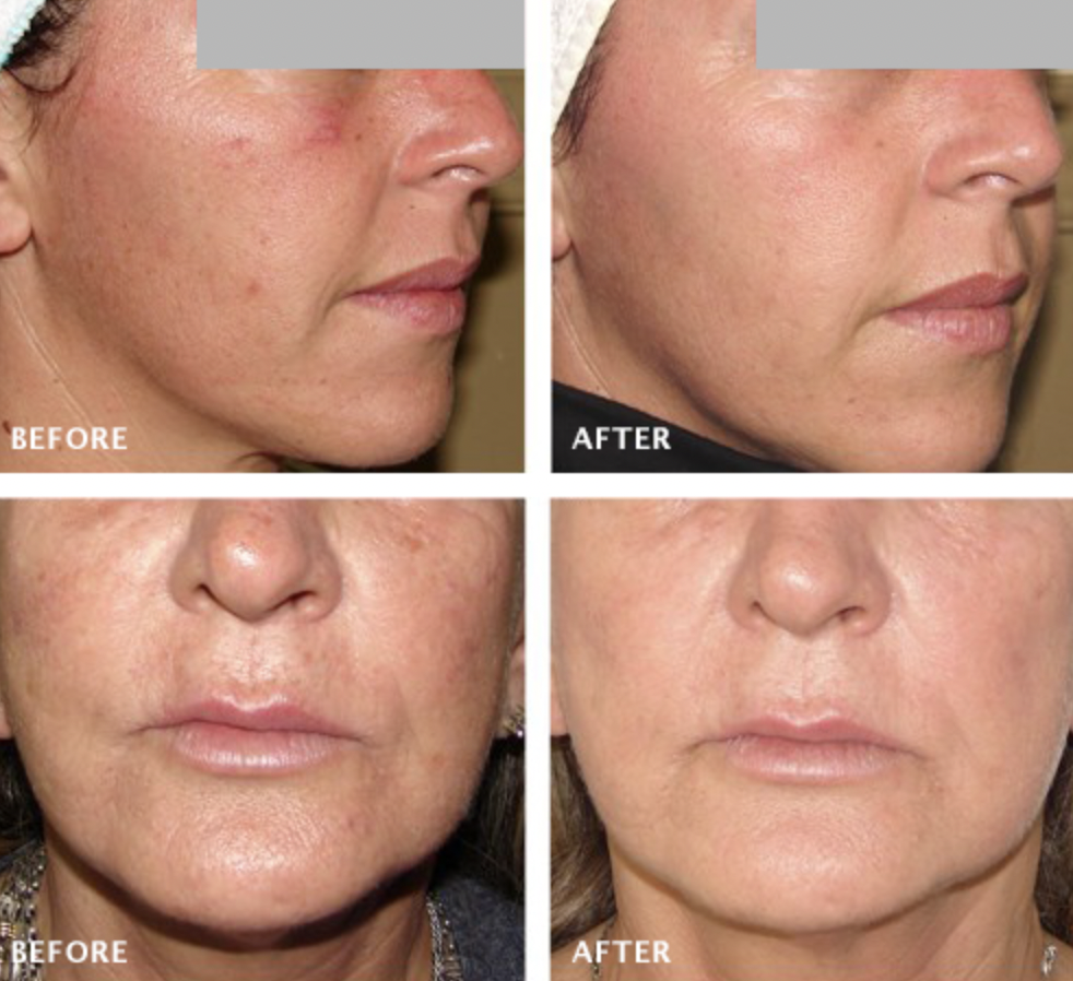Before and after using light therapy for skin tightening