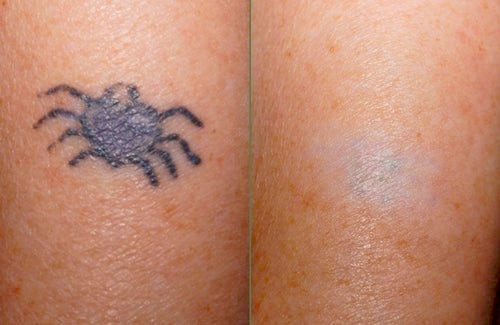 Is the neatcell picosecond pen good for removing tattoo : r/TattooRemoval