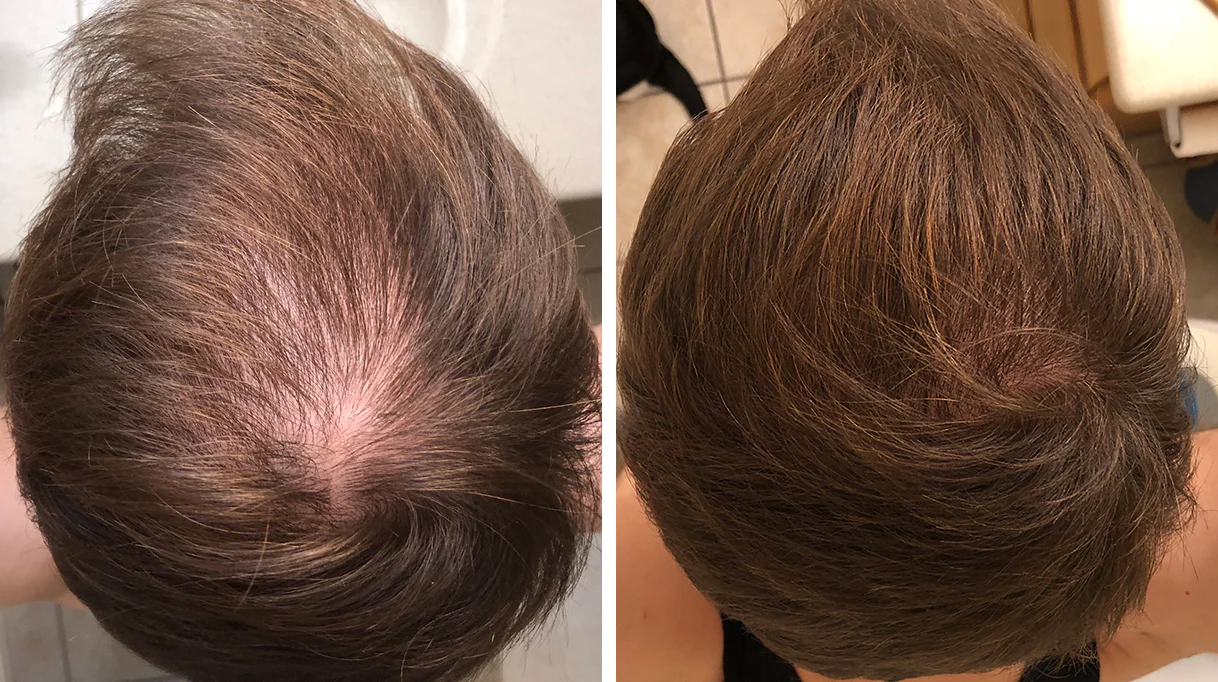 Results after using iRestore Professional Laser Hair Growth System for 25 weeks