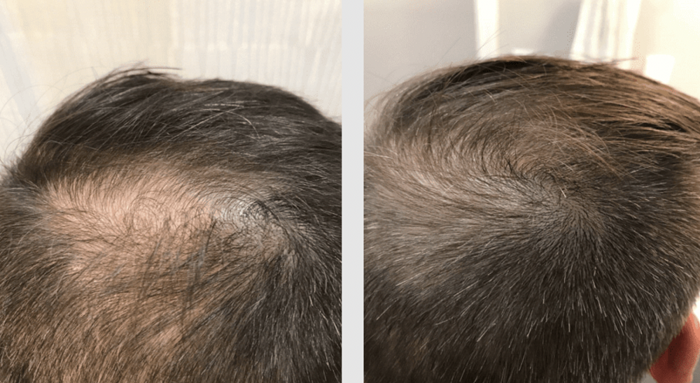 Results of laser cap for hair loss treatment