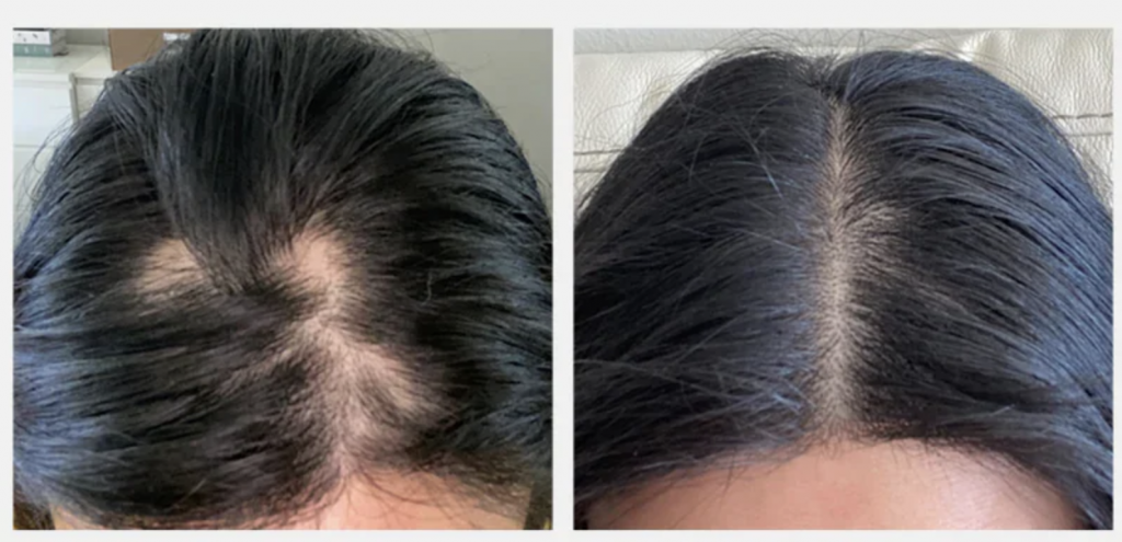 Results of laser cap for hair loss treatment